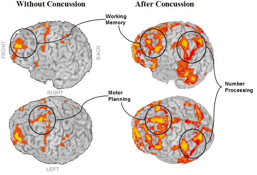 Concussions And Its Effects On Society